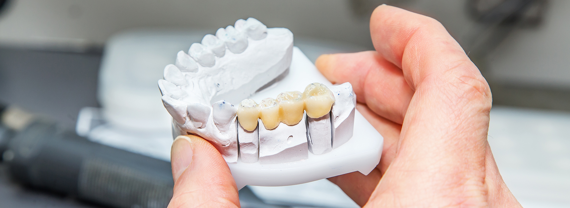 The image shows a person s hands holding a dental model, which appears to be a set of upper and lower dentures or dental implants.