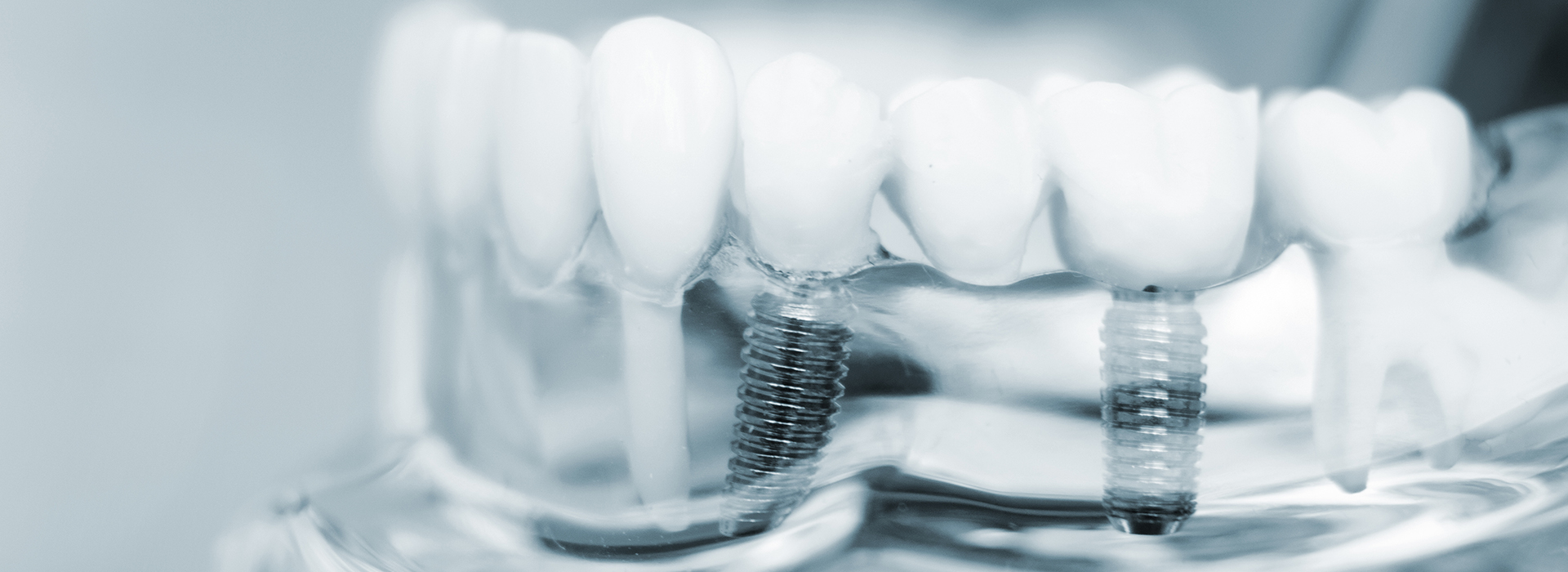 The image displays a close-up of dental implants with screws visible, against a blurred background that suggests a medical or dental setting.