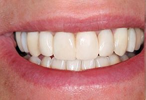 The image shows a close-up of a person s smiling face, focusing on their teeth and mouth.