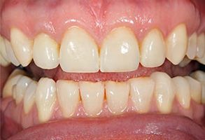 The image shows a close-up of a person s teeth, which appear to be in need of dental care.