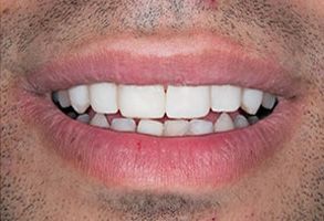 An image of a person with a broad smile, showcasing their teeth and lips, against a neutral background.