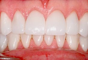 The image shows a close-up of an individual s teeth, which appear to be in the process of being straightened or aligned.