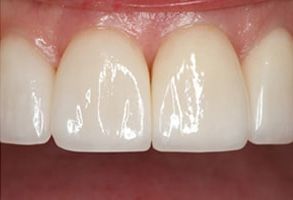 The image displays a close-up of a person s teeth, showcasing a bright smile with white fillings and a gumline that appears healthy.