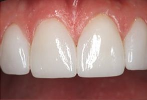 The image shows a close-up of a person s teeth with a focus on the lower front teeth, which are prominently displayed.