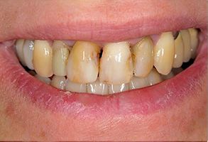 The image displays a close-up of a person s teeth, showcasing a yellowish discoloration that may indicate dental issues such as staining or decay.