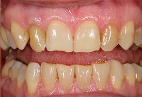 The image shows a close-up of a person s teeth with an overbite, where the upper front teeth are more prominent than the lower ones.