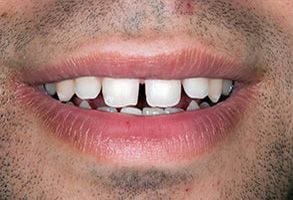 The image shows a close-up of a person s lips and teeth, with the lower lip slightly parted, revealing a partial view of the teeth.
