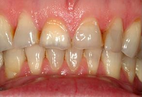 The image shows a close-up of a person s teeth with yellow stains, indicating the presence of nicotine or other staining substances.