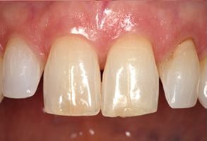 The image shows a close-up of a person s teeth with visible signs of decay and discoloration, particularly at the front where the teeth are chipped and yellowed.