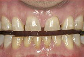 The image shows a person s mouth with yellowed teeth, some of which are missing, and the upper lip is slightly pulled back to reveal the teeth.