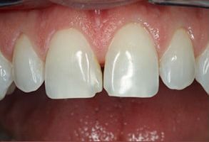 The image shows a close-up of a person s teeth with the upper lip slightly visible, revealing a partial view of the lower lip and chin.